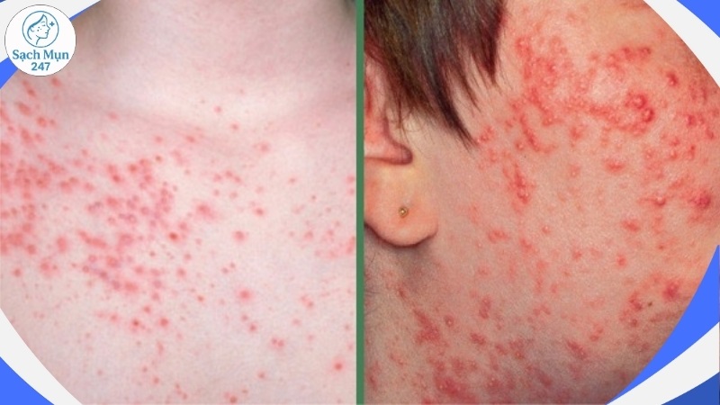 Phát ban mụn trứng cá là gì?