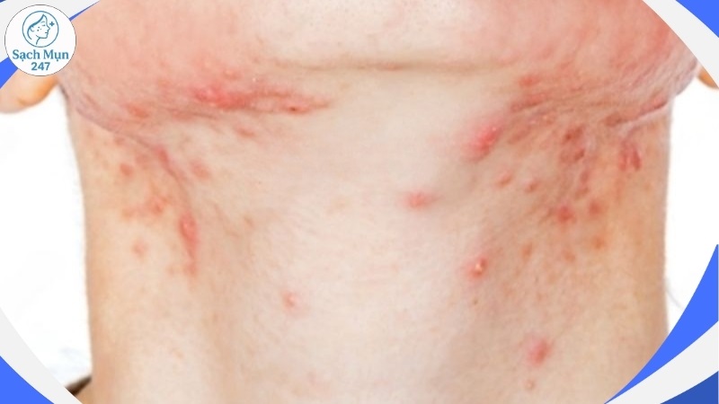 Phát ban mụn trứng cá ở cổ