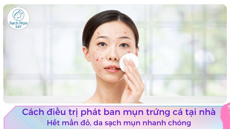 cách điều trị phát ban mụn trứng cá
