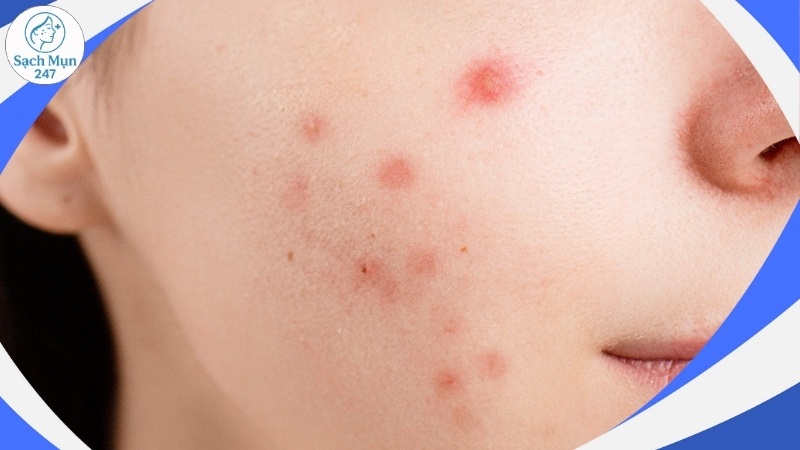 Nguyên nhân gây mụn trứng cá