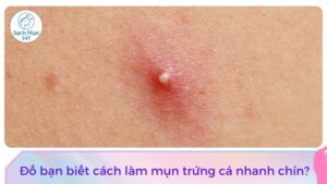 cách làm mụn trứng cá nhanh chín