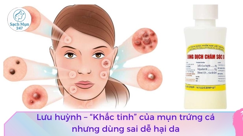 Lưu huỳnh trị mụn trứng cá