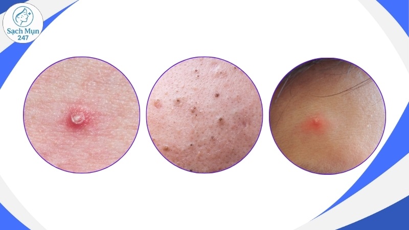 Các loại mụn trứng cá