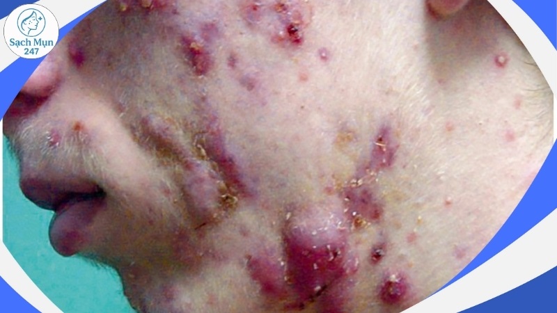 Mụn trứng cá mạch lươn