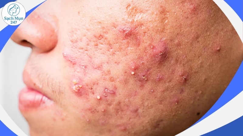 mụn trứng cá mạch lươn