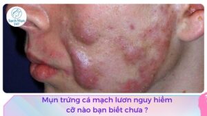 Mụn trứng cá mạch lươn