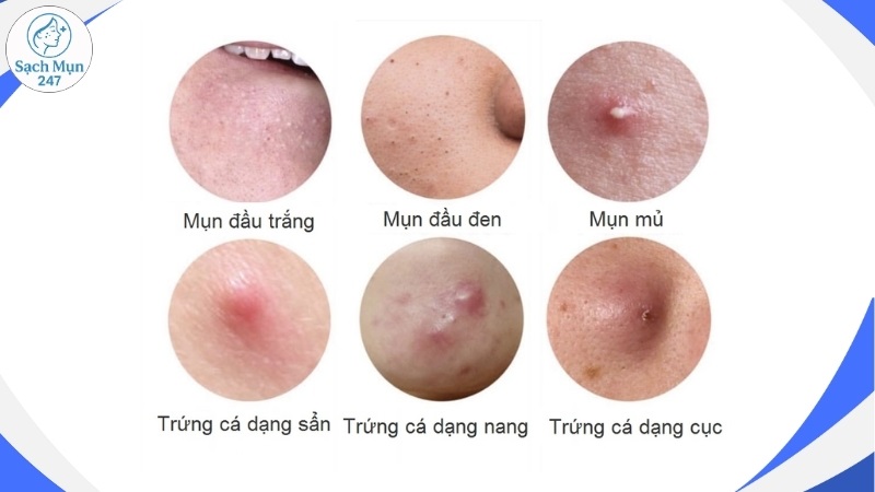 Phân loại mụn trứng cá ở má