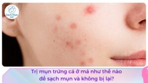 mụn trứng cá ở má