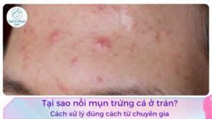 mụn trứng cá ở trán