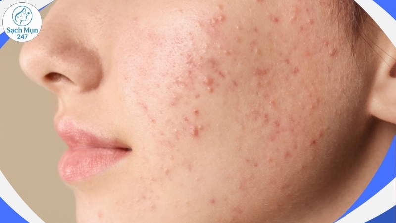 Mụn trứng cá nổi nhiều