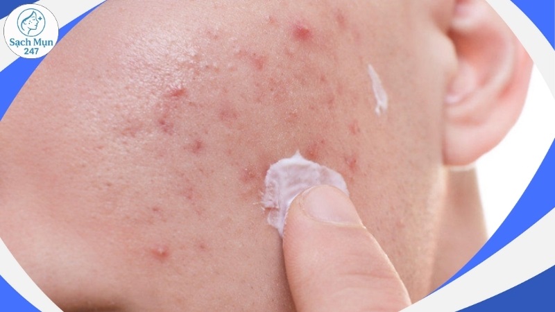 Phương pháp điều trị mụn do vi khuẩn