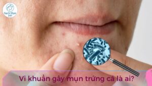 vi khuẩn gây mụn trứng cá