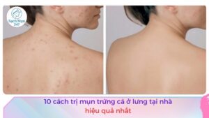 cách trị mụn trứng cá ở lưng tại nhà