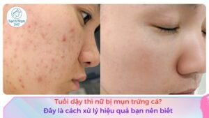 cách trị mụn trứng cá ở tuổi dậy thì nữ