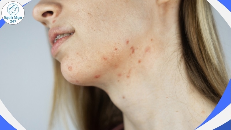 bị mụn trứng cá ở cổ