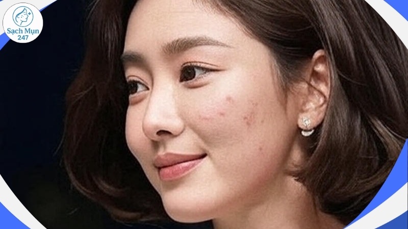 Mụn trứng cá ở tuổi trung niên