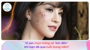 mụn trứng cá ở tuổi trung niên