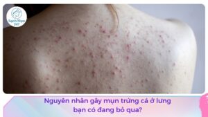 nguyên nhân gây mụn trứng cá ở lưng